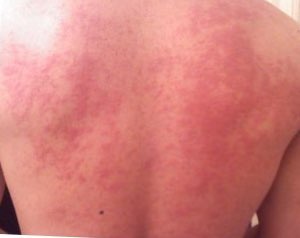 Food Allergies