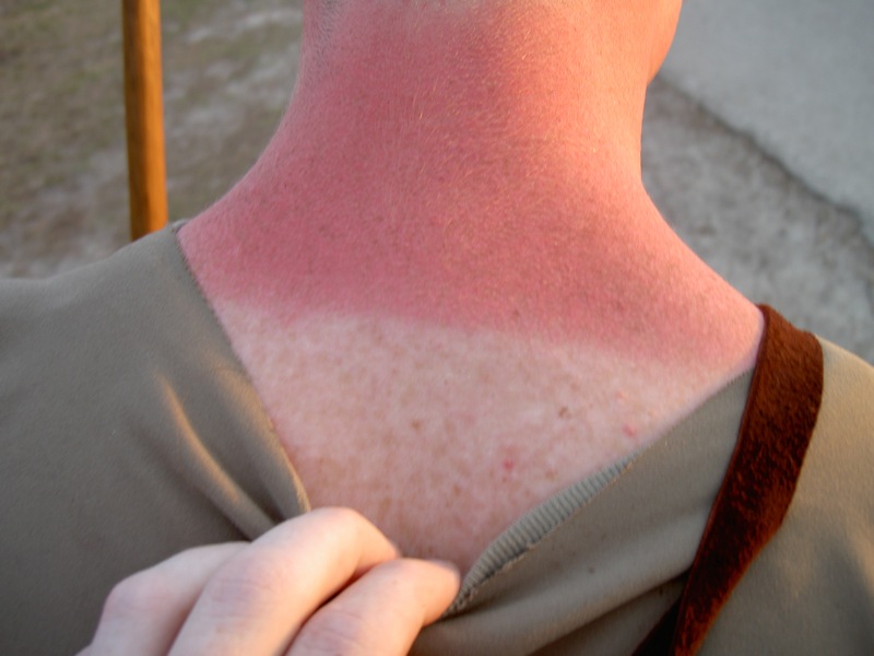 Sunburn Prevention